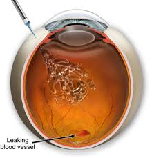 Intra vitreal steroid injection