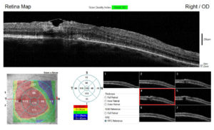 macula